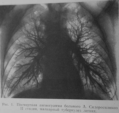 Сидеросиликоз II стадия, милиарный туберкулёз лёгких