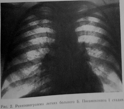 Пневмокониоз рентген фото